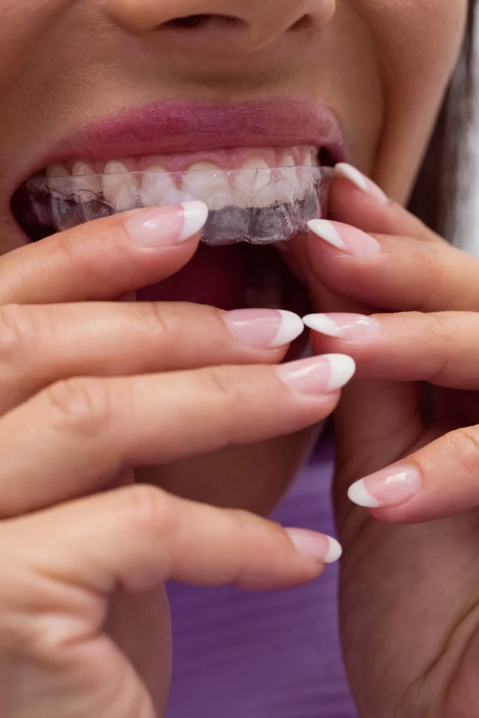 A professional close-up macro photograph showing a female patient utilizing both hands to carefully insert a transparent clear aligner orthodontic tray onto her upper teeth. This image represents the discrete Invisalign placement process, comfortable clear aligner insertion techniques, and user-friendly cosmetic orthodontic treatments delivered at icónica dental group.