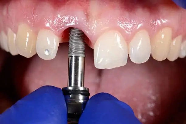 A professional close-up intraoral photograph showing a surgical instrument driver engaging a titanium dental implant body during insertion into the upper central incisor socket space. A clinician wearing blue protective gloves handles the specialized component with precision. This image represents the advanced surgical implant placement, precise torque stabilization protocols, and single tooth implant engineering executed at icónica dental group.