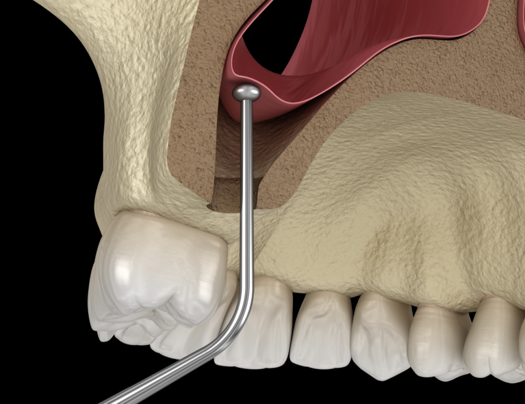 A detailed medical illustration showing a cross-section diagram of a sinus lift oral surgery procedure. A surgical instrument gently elevates the pink sinus membrane from the maxillary bone floor above the upper teeth to prepare the anatomical site for bone grafting and permanent dental implant placement. This image represents the advanced surgical focus, specialized bone grafting protocols, and implant site development provided at icónica dental group.