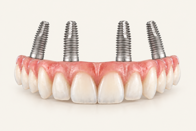Illustration of a fixed full-arch restoration supported by four dental implants