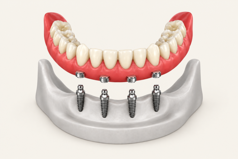 Removable lower snap-on denture lifted above four implant attachments