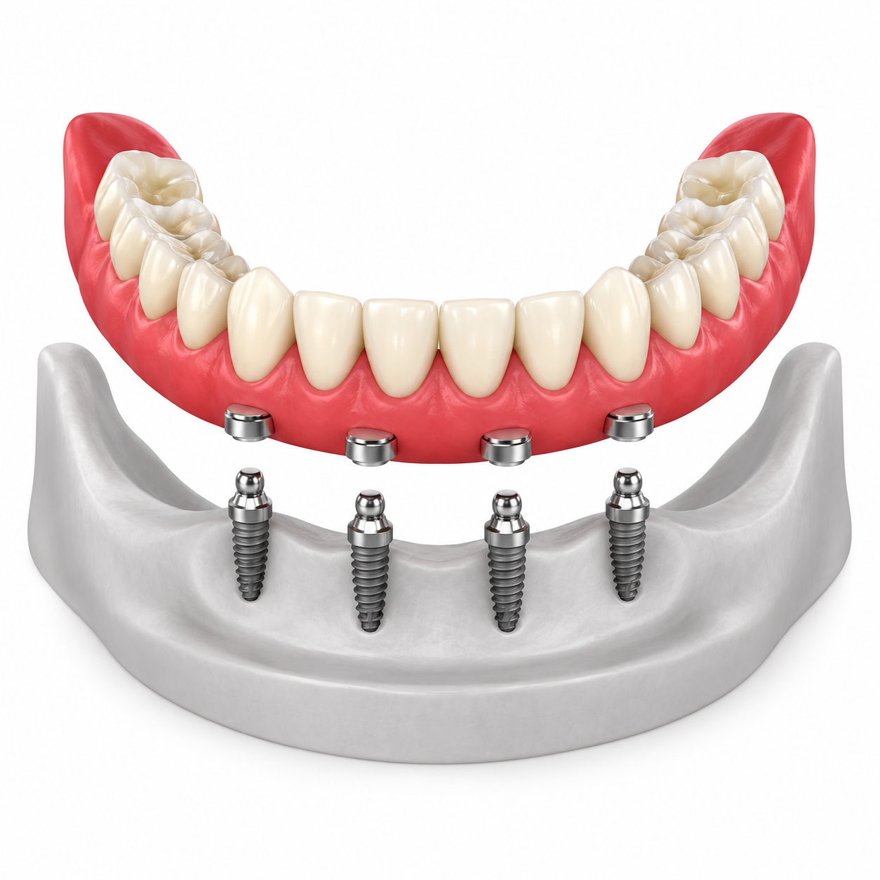 Illustration of a lower removable overdenture aligned with four implants across the front of the lower jaw.