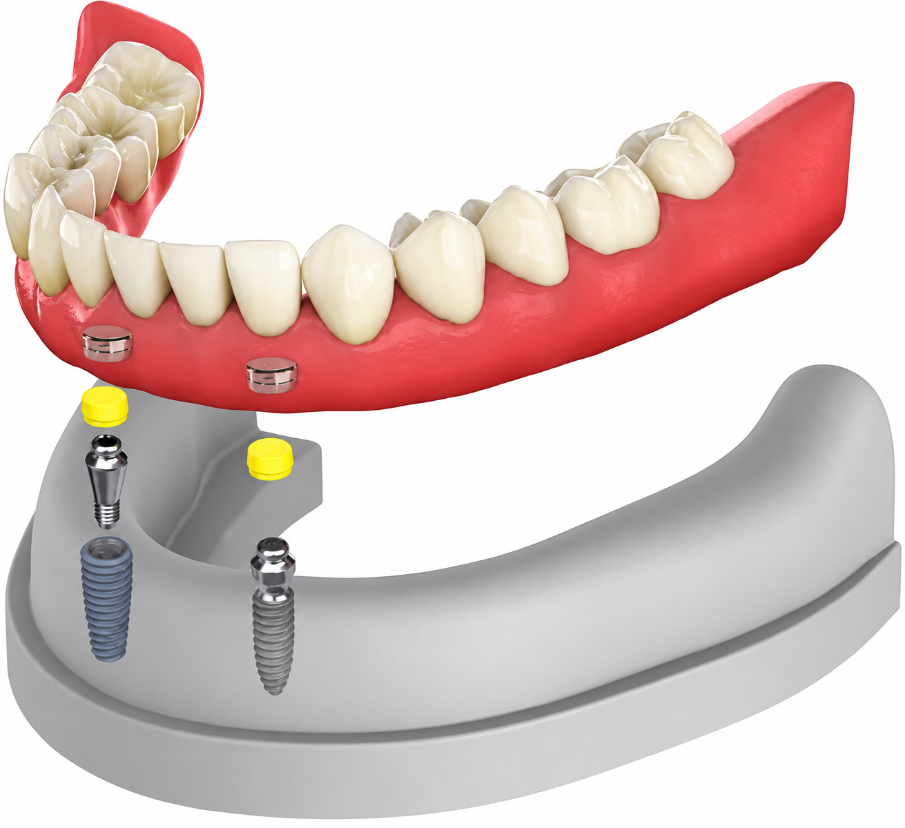 Lower snap-on denture shown over two implant attachments